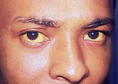 yellowing of the eyes, indicating jaundice