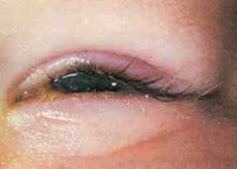 a partially open eye showing conjunctivitis