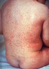 the rubella rash on a childs back