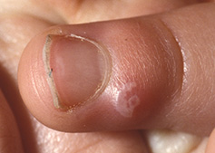 A blister on a thumb, just below the bottom of the nail