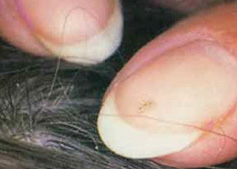 small white or brown oblong eggs ('nits') attached to the hair shafts shafts small white or brown oblong eggs ('nits') attached to the hair shafts shafts