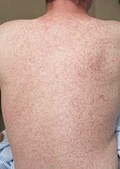 an adult with the measles rash all over their back